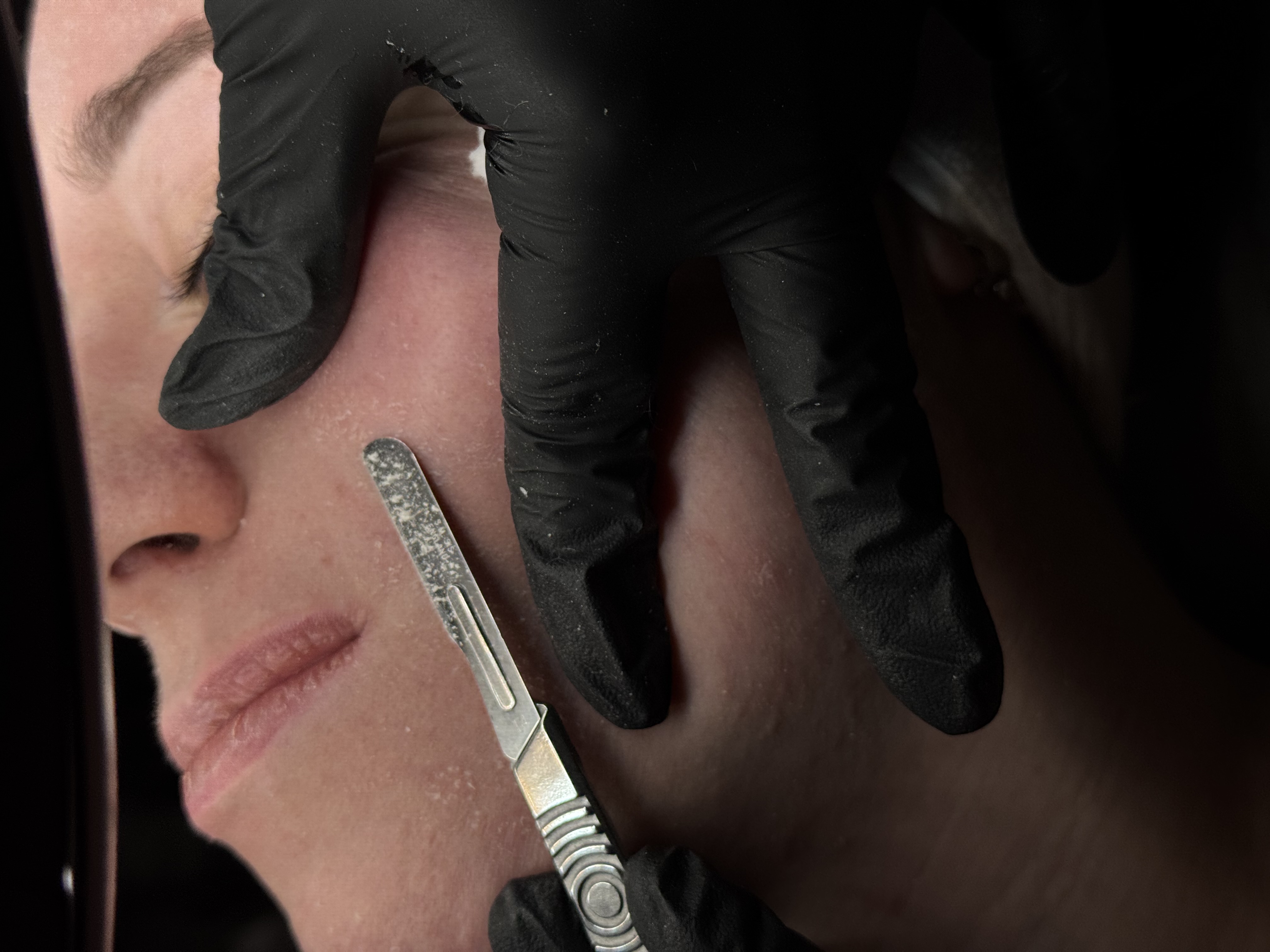 Dermaplaning facial close-up in Valencia